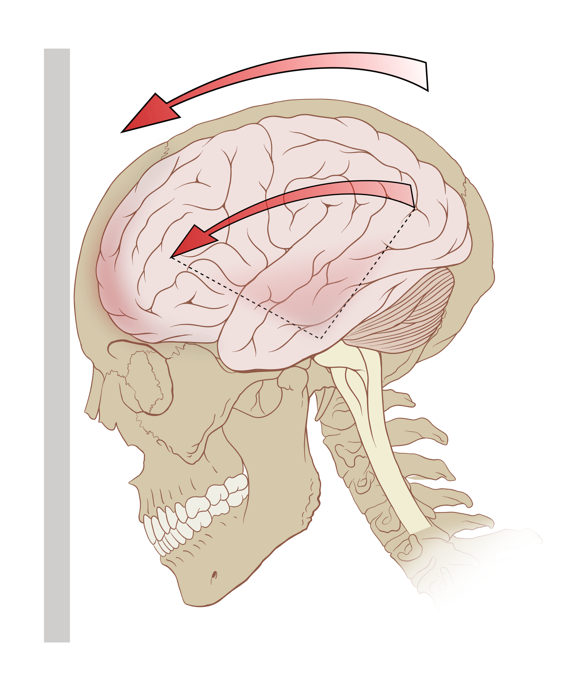 concussion